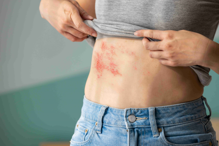 Хвороба викликана вірусом, що знаходиться в організмі Не чіпай, а то підхопиш – лікарі розкрили 5 найпоширеніших міфів про оперізуючий лишай 1