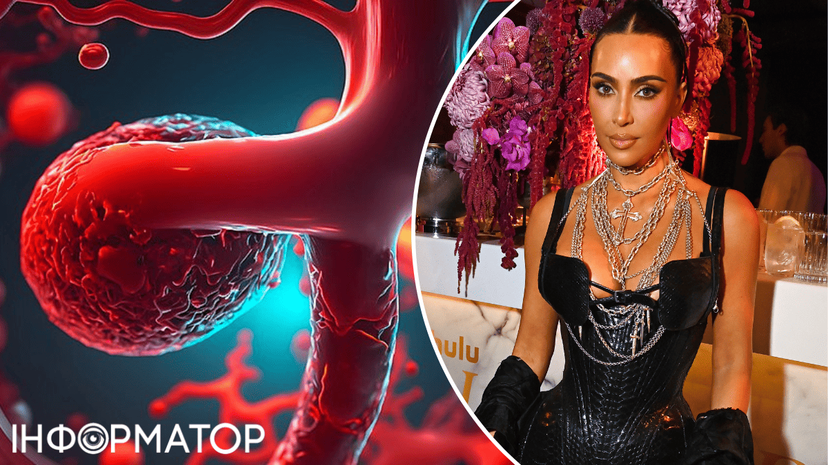 Если не учитывать кокаин: как не подхватить болезнь, подкосившую Ким Кардашьян