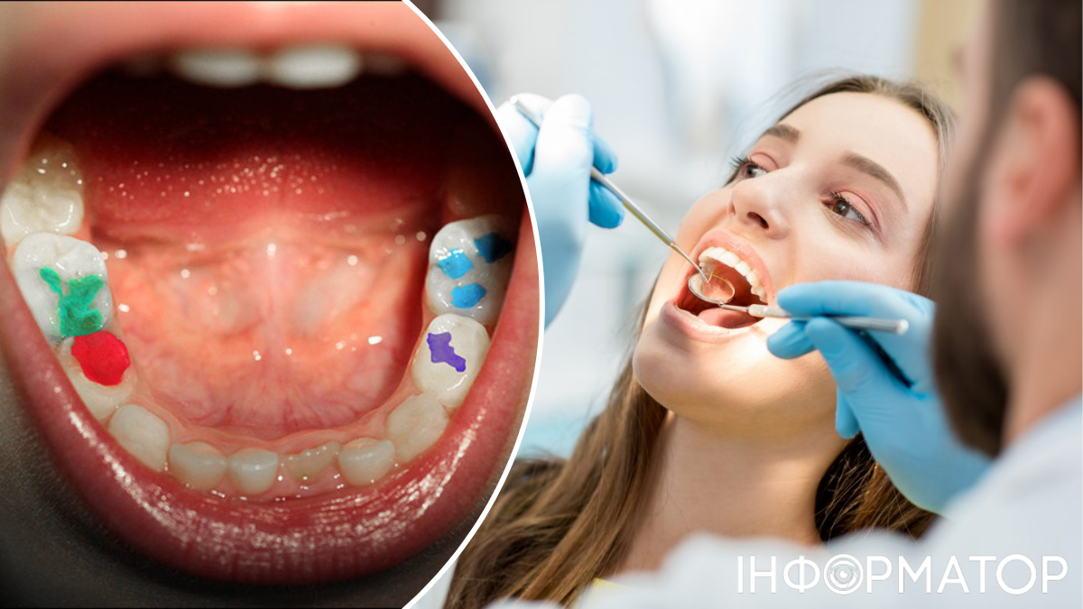 150 стран согласились отказаться от пломб в стоматологии – это обязательное решение