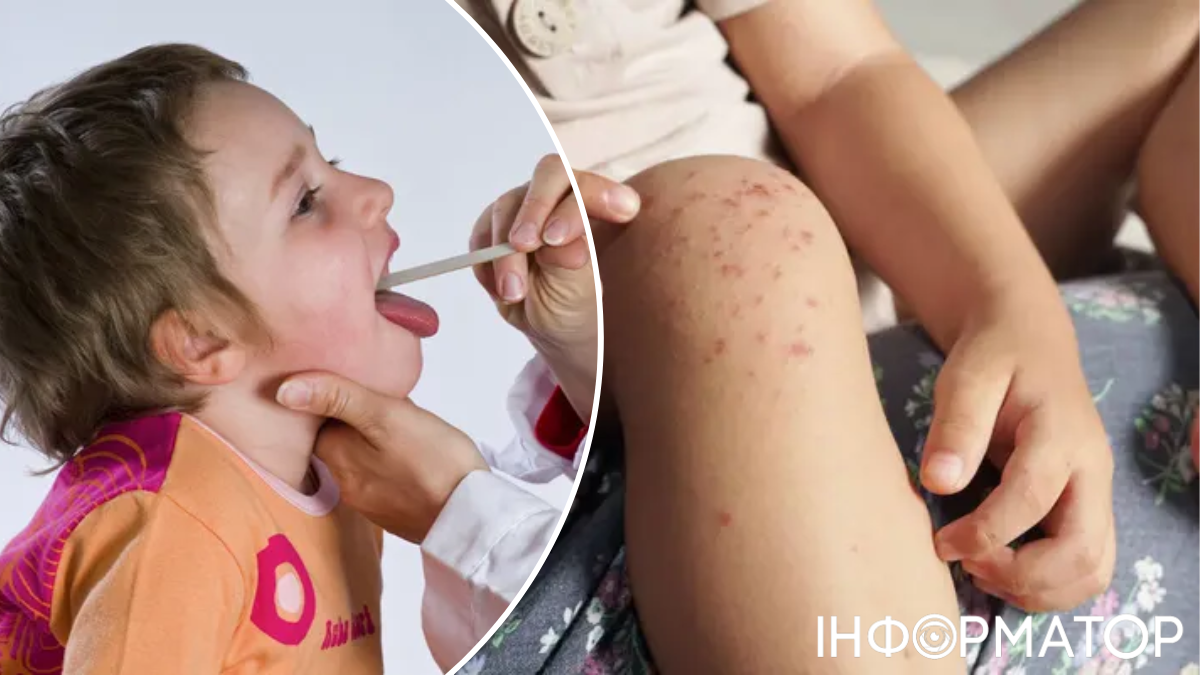 Вірус Коксакі зʼявився на Полтавщині: кількість захворювань зростає
