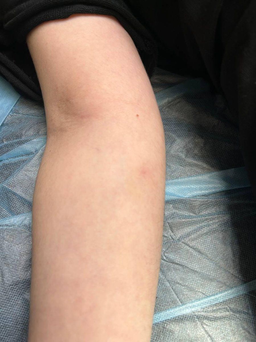 Через блекаут дівчинка зі Львова тиждень ходила з голкою в руці 1