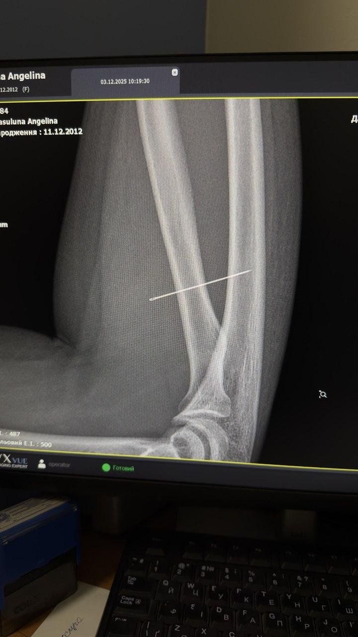 Через блекаут дівчинка зі Львова тиждень ходила з голкою в руці 2