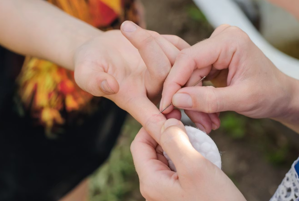 Діставати скалку треба обережно Здавалося б дрібниця: коли скалка може стати серйозною проблемою та як її правильно дістати 2