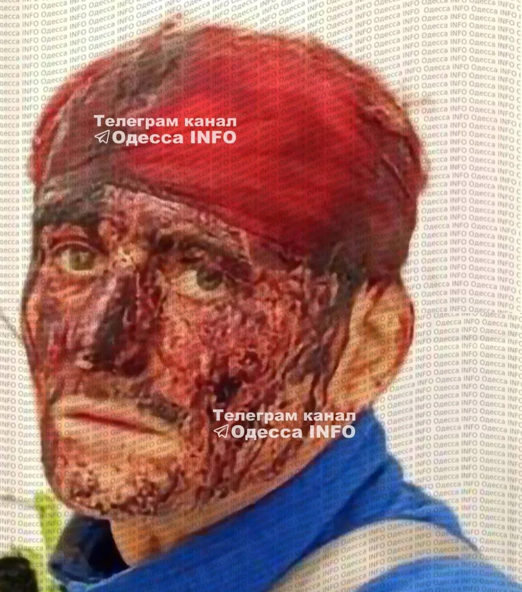 В Одесі новий конфлікт з ТЦК: з'явилося фото чоловіка у крові - військові кажуть, що він сам завдав собі ушкоджень 1