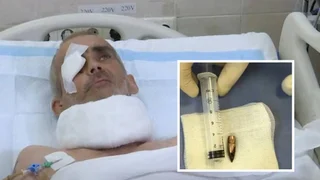 Провели унікальну операцію: у Дніпрі лікарі врятували воїна, через голову якого пройшла куля