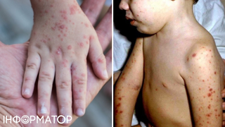 Україною шириться спалах вірусу Коксакі - він ховається під застуду, але призводить до менінгіту