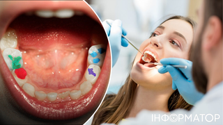 150 країн погодилися відмовитися від пломб у стоматології – це обов'язкове рішення