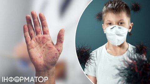 Хвороба Коксакі: серед людей є найвразливіша категорія - це дійсно лякає