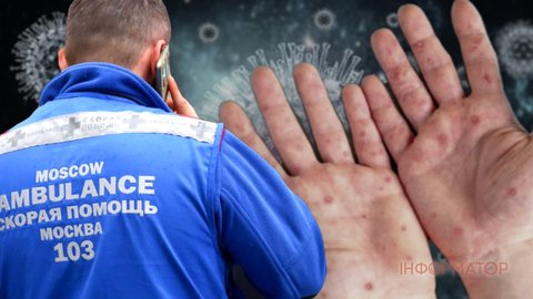 В Подмосковье заподозрили вспышку обезьяньей оспы - пять человек госпитализированы