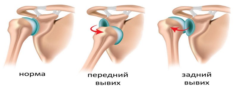 Вывих плечевого сустава: основные характеристики диагноза