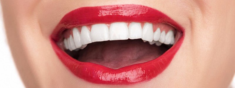 Виниры на зубы – ослепительная улыбка на всю жизнь