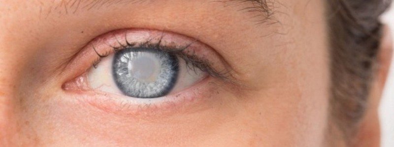Глаукома: симптомы, лечение и кто в зоне риска