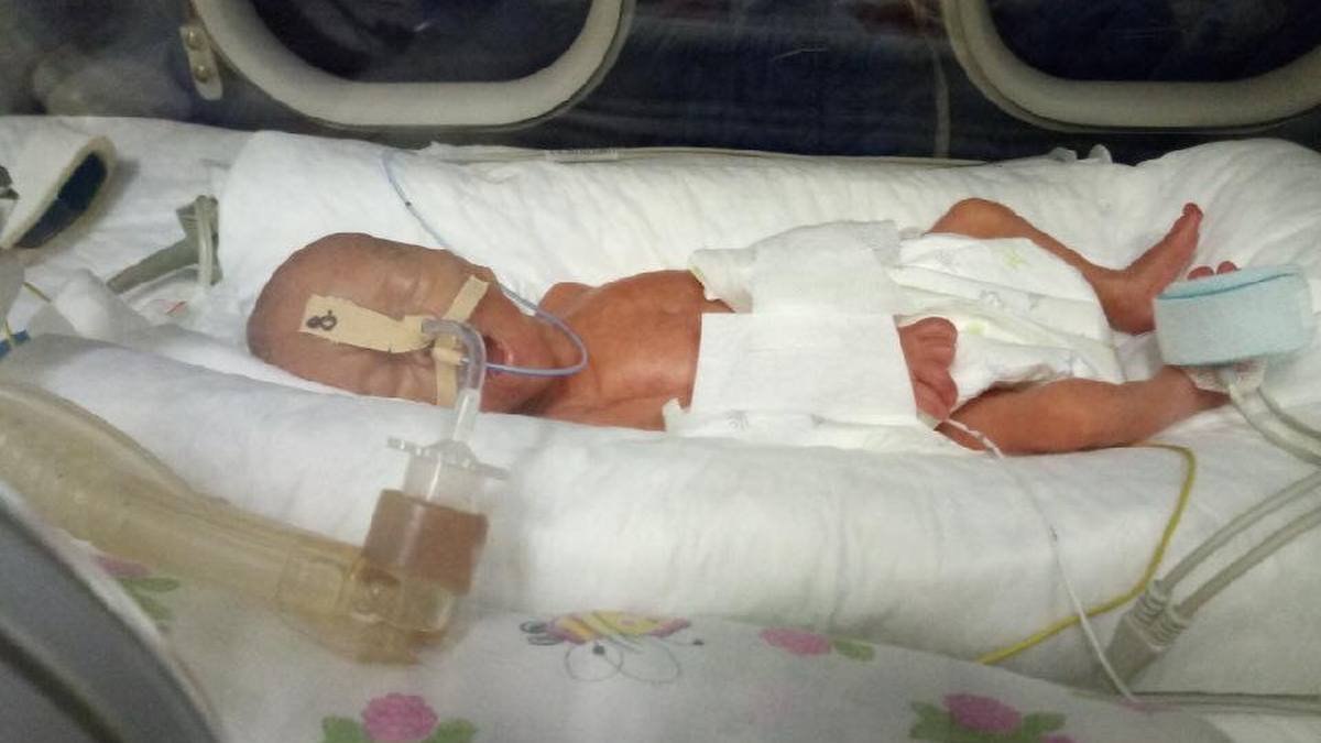 В Днепре спасают девочку, которая родилась на 23-й неделе, с весом 650 граммов