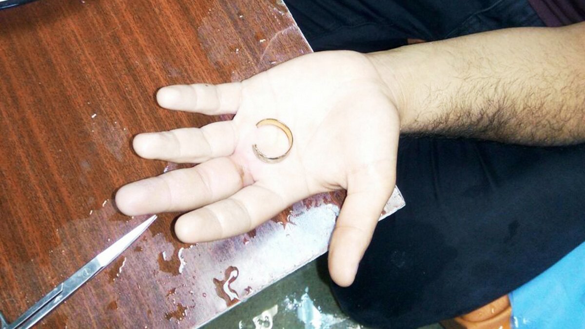 В Днепре мужчина не мог самостоятельно снять кольцо: пришлось вызывать спасателей
