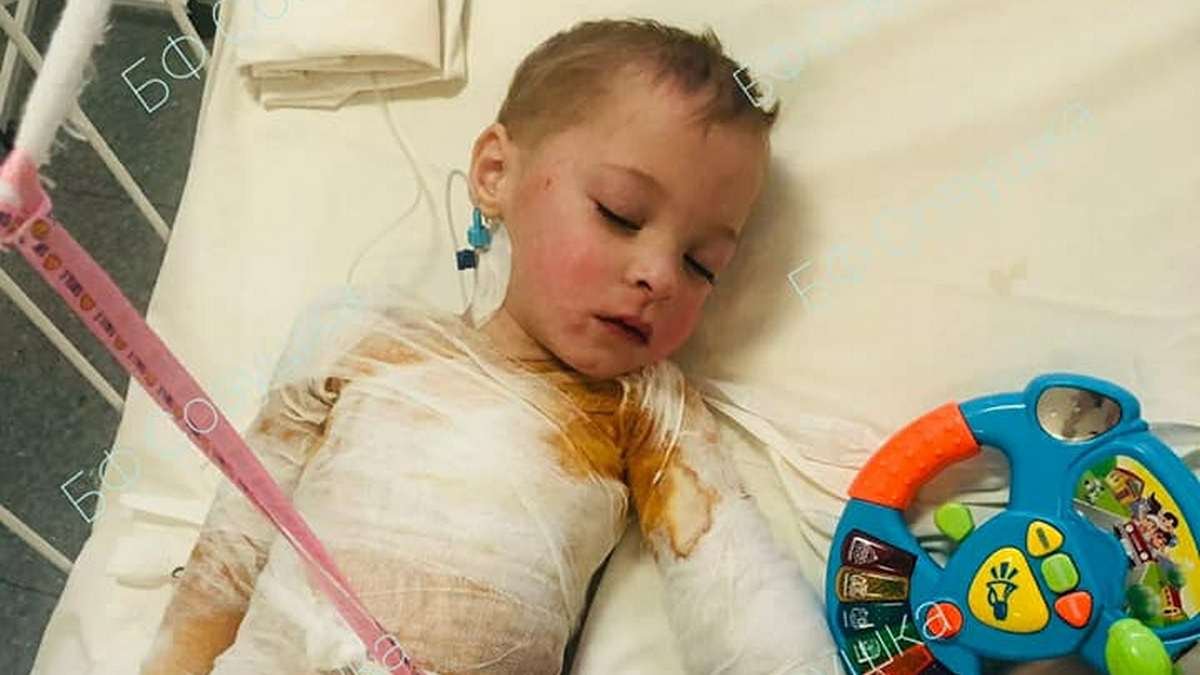 В Днепре 3-летний малыш опрокинул кастрюлю с кипятком: самочувствие ребенка