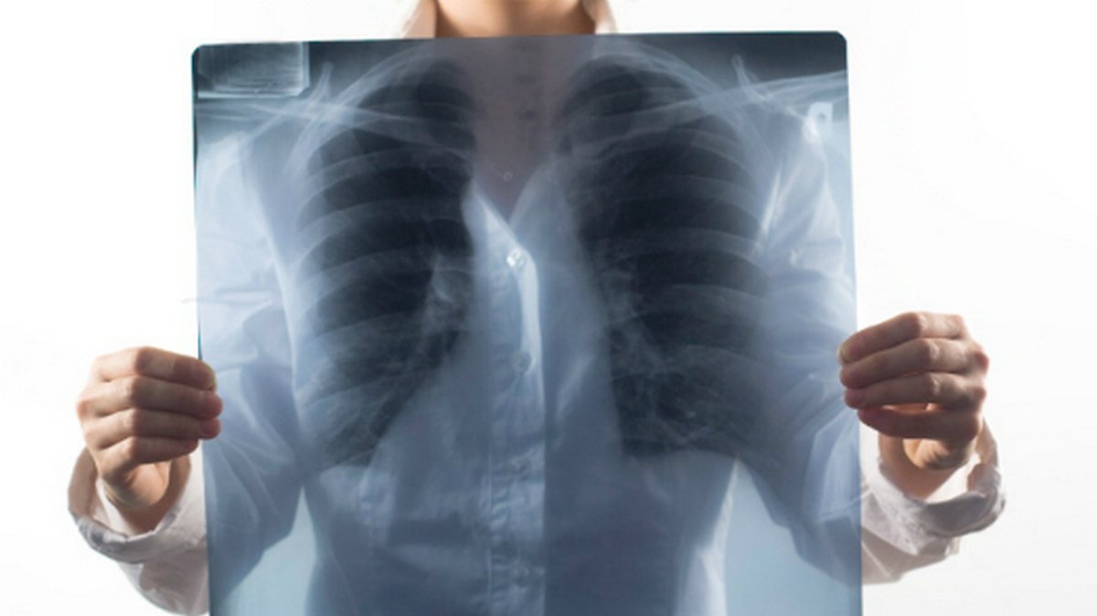 Жителей Днепра и области приглашают бесплатно обследоваться на туберкулез