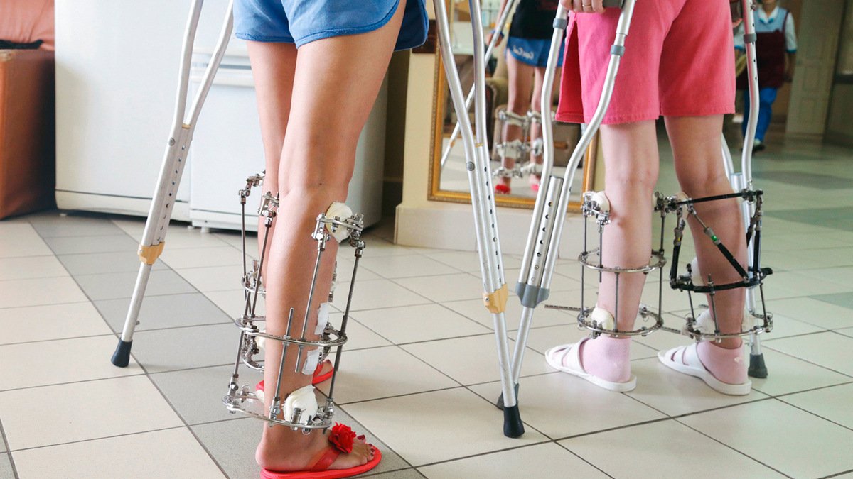 В больнице Руднева в Днепре 16-летней девочке удлинили ногу на 13 сантиметров