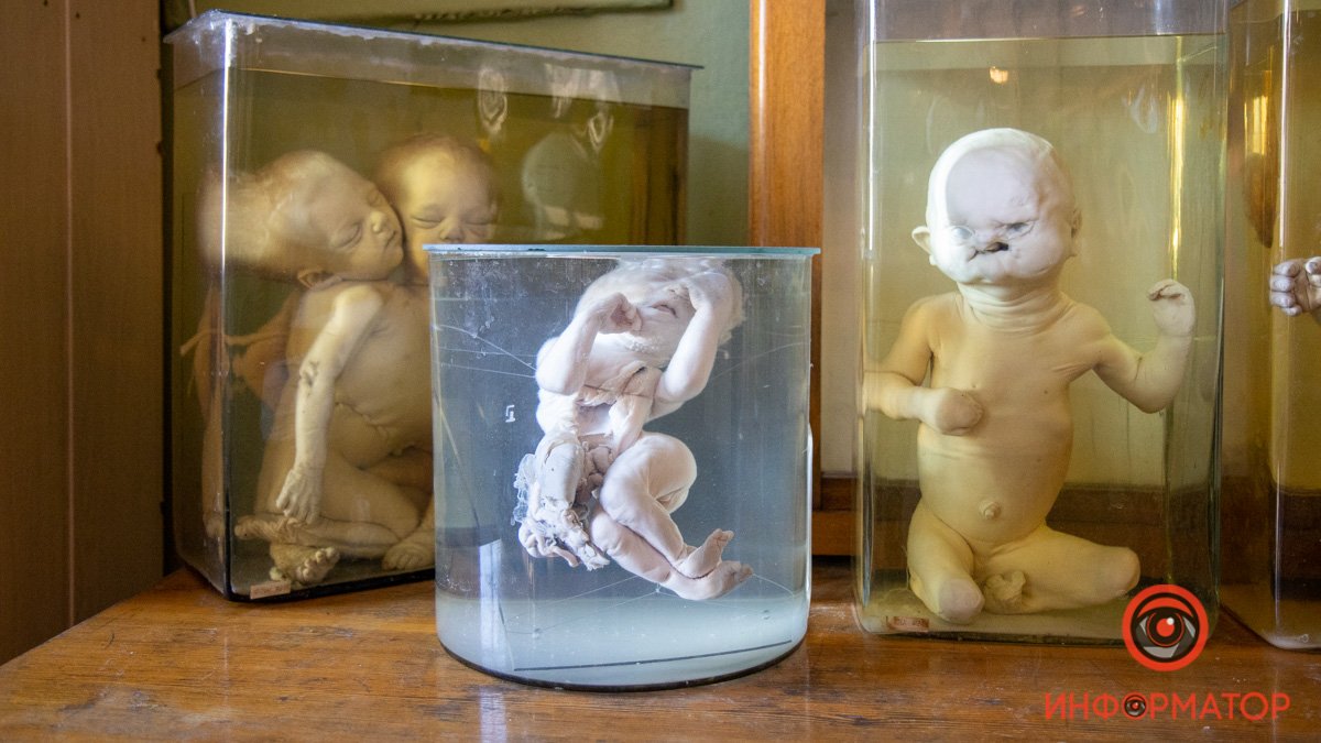Сиамские близнецы, мумии и легкие курильщика: что можно увидеть в Анатомическом музее в Днепре