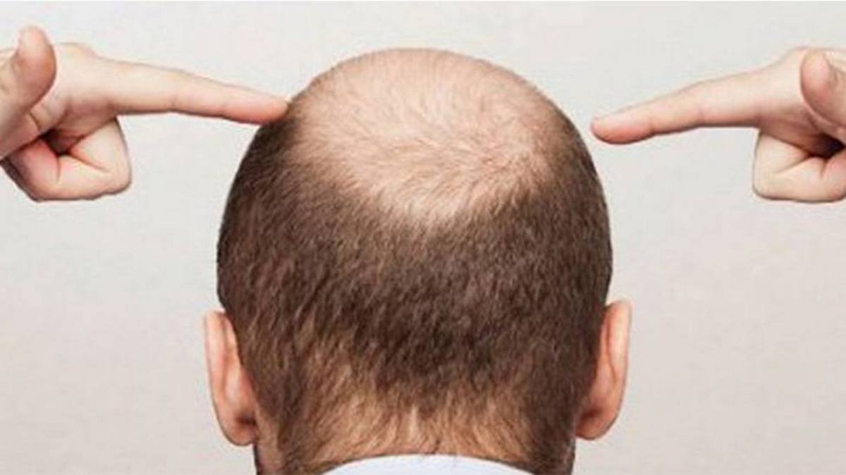 Постковидное выпадение волос: что говорят врачи
