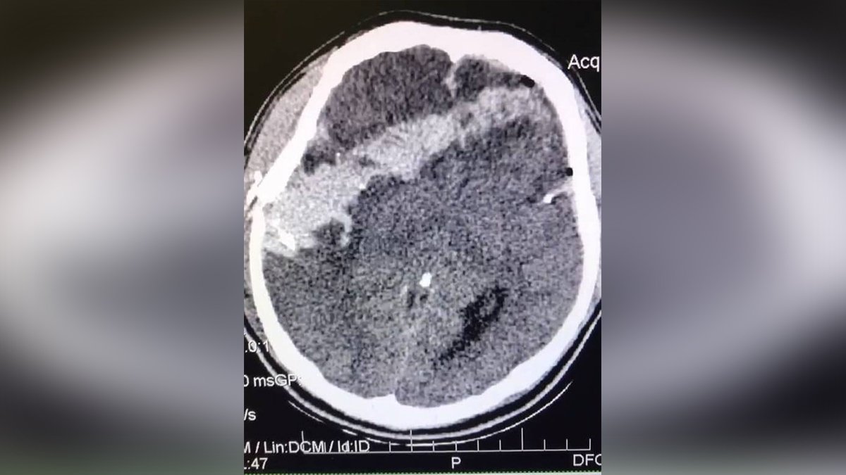 Пуля остановилась в мозге: в Днепре спасают 21-летнего мужчину с тяжелым ранением
