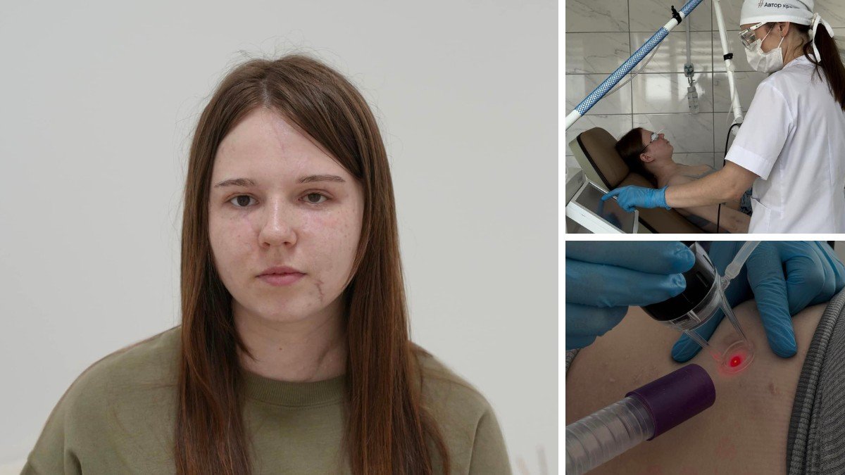 Обломок застрял в миллиметре от сонной артерии: днепровские врачи спасли девушку из Северодонецка, которой вражеская ракета изуродовала лицо