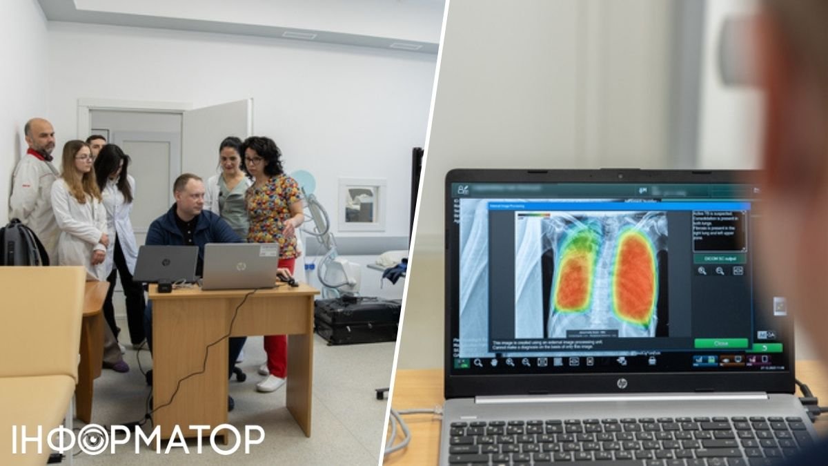 В Україні почали діагностувати туберкульоз за допомогою ШІ: як це відбувається