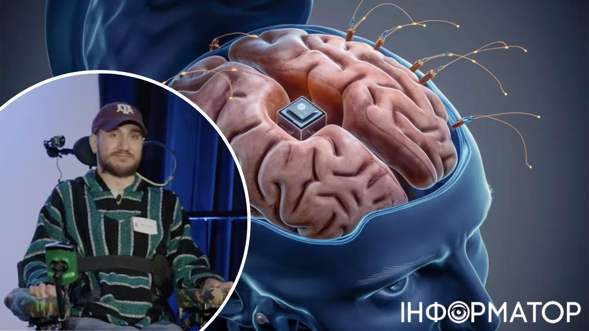Первый человек с чипом Neuralink в мозгу от Илона Маска столкнулся с проблемами с устройством
