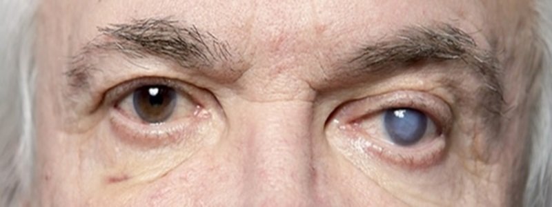 Как жителям Днепра сберечь зрение и какие есть методы лечения глазных болезней
