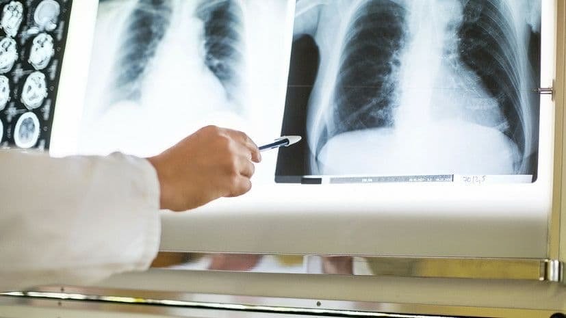 В мае 2021 года в Украине зарегистрировали 1 321 случай туберкулёза