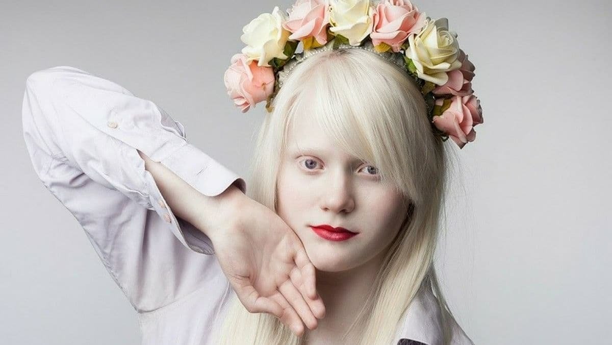 13 июня: Международный день распространения информации об альбинизме