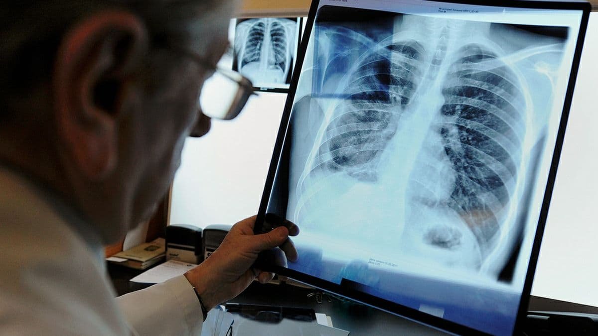 У червні 2021 року в Україні зареєстрували 1 542 випадки туберкульозу