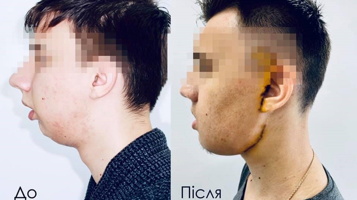 В Україні вперше провели складну операцію. Лікарі змінили обличчя хлопцеві, який в дитинстві потрапив в аварію