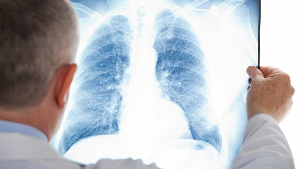 В августе 2021 года в Украине зарегистрировали 1 622 случая туберкулёза