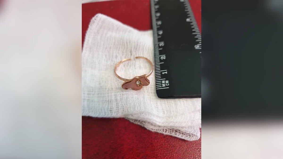 Во Львове врачи два часа спасали годовалую девочку, которая проглотила кольцо