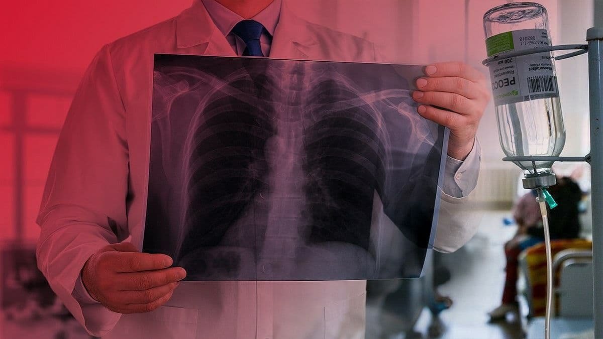 В октябре 2021 года в Украине подтвердили 1 554 случая туберкулёза