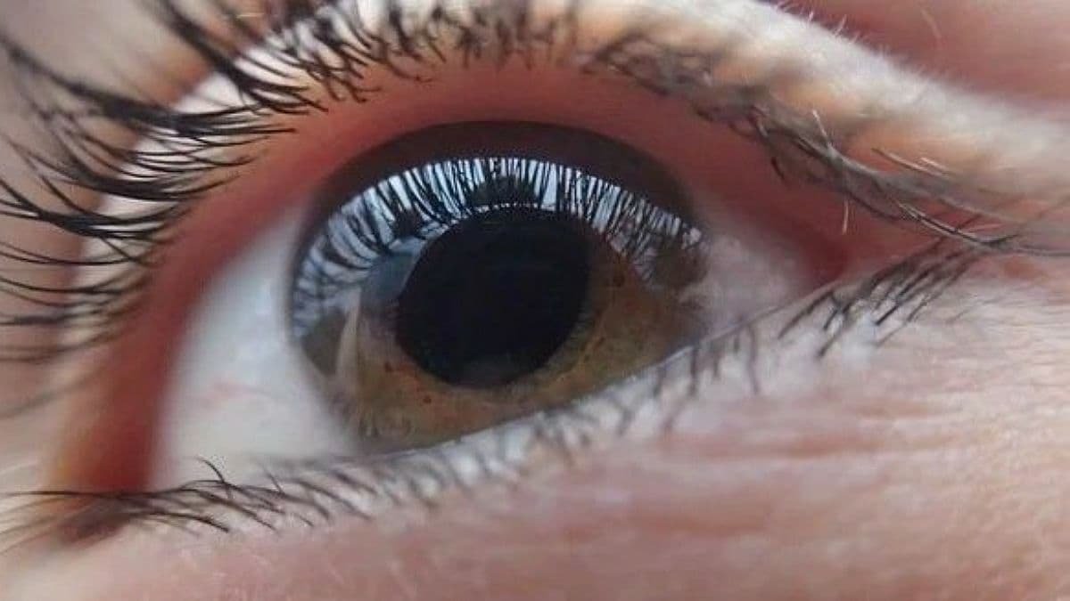 В Великобритании мужчине пересадили протез глаза, напечатанный 3D-принтером: это первый такой случай в мире