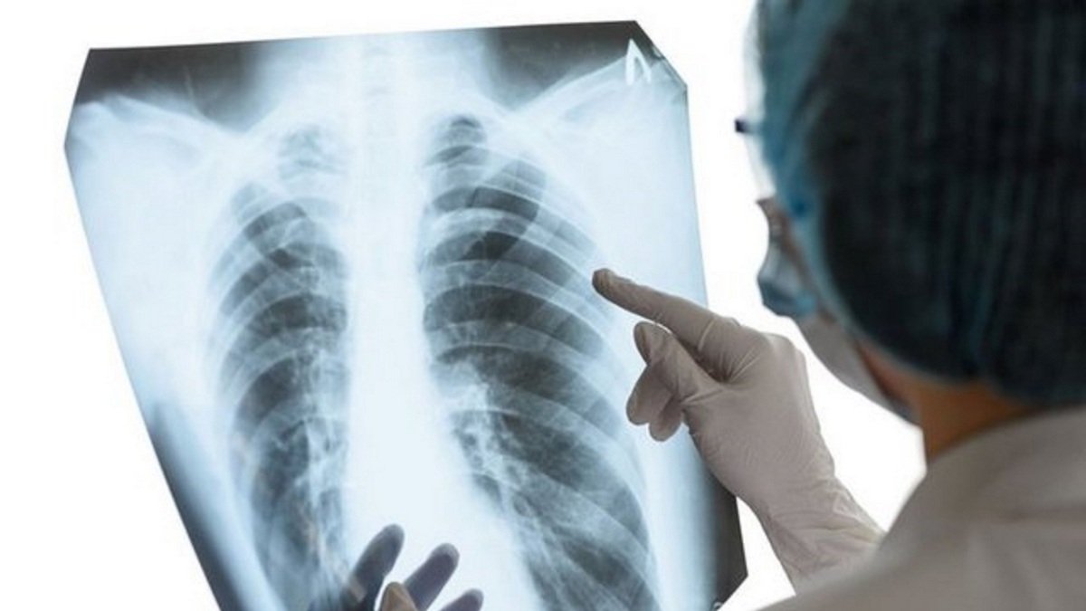 Українці з туберкульозом можуть отримати безкоштовну медичну допомогу