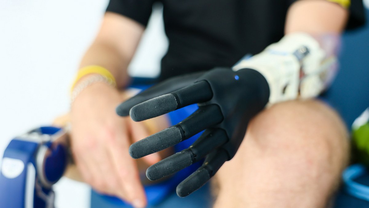 Во Львове украинскому военному установили первый бионический протез: он потерял руку в боях под Изюмом