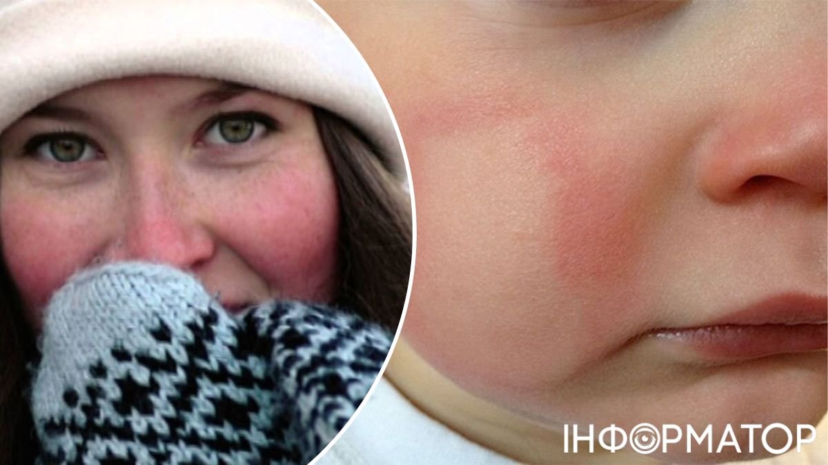Зловісні ознаки того, що у вас алергія на холод: не просте почервоніння